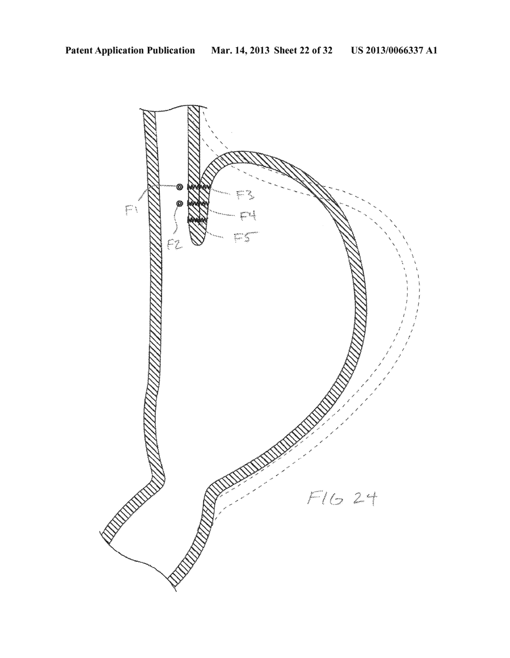 METHODS AND DEVICES FOR MANIPULATING AND FASTENING TISSUE - diagram, schematic, and image 23