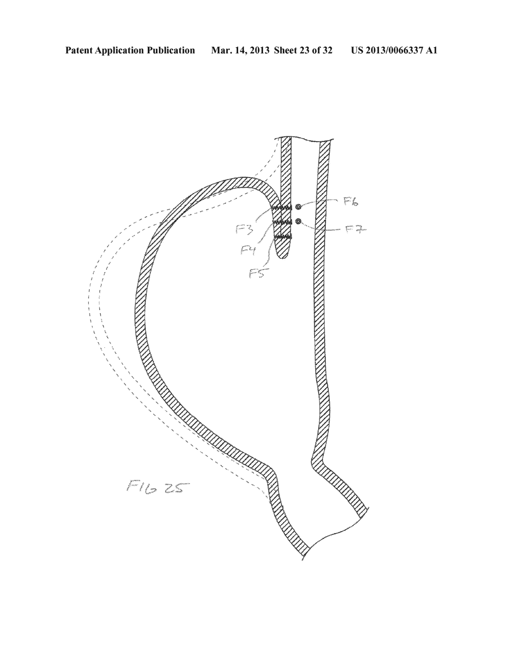 METHODS AND DEVICES FOR MANIPULATING AND FASTENING TISSUE - diagram, schematic, and image 24