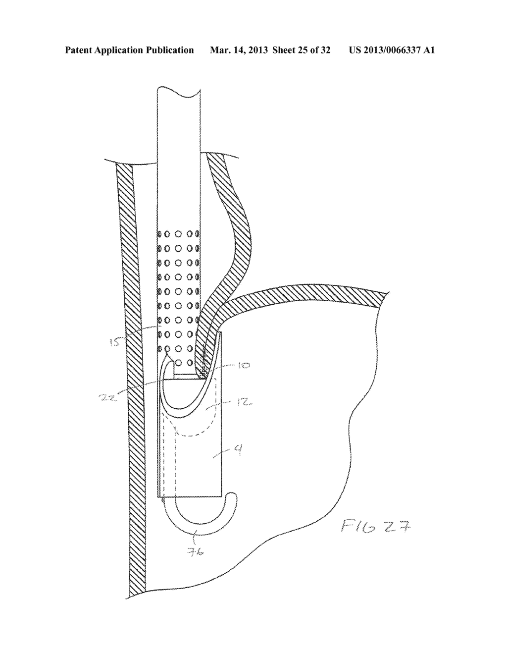 METHODS AND DEVICES FOR MANIPULATING AND FASTENING TISSUE - diagram, schematic, and image 26