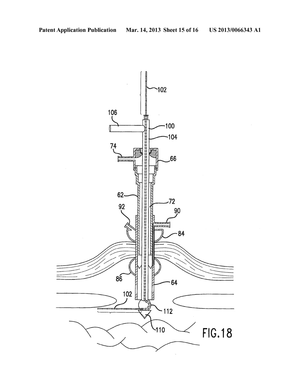 DEVICE AND METHOD FOR DELIVERING GRAFTS - diagram, schematic, and image 16