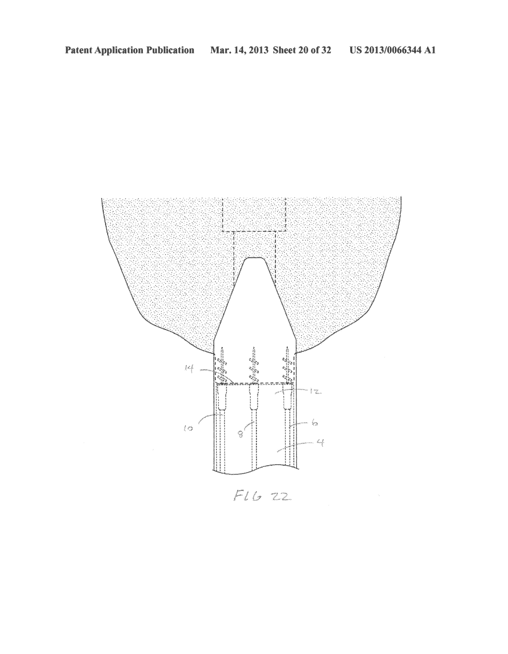 METHODS AND DEVICES FOR MANIPULATING AND FASTENING TISSUE - diagram, schematic, and image 21