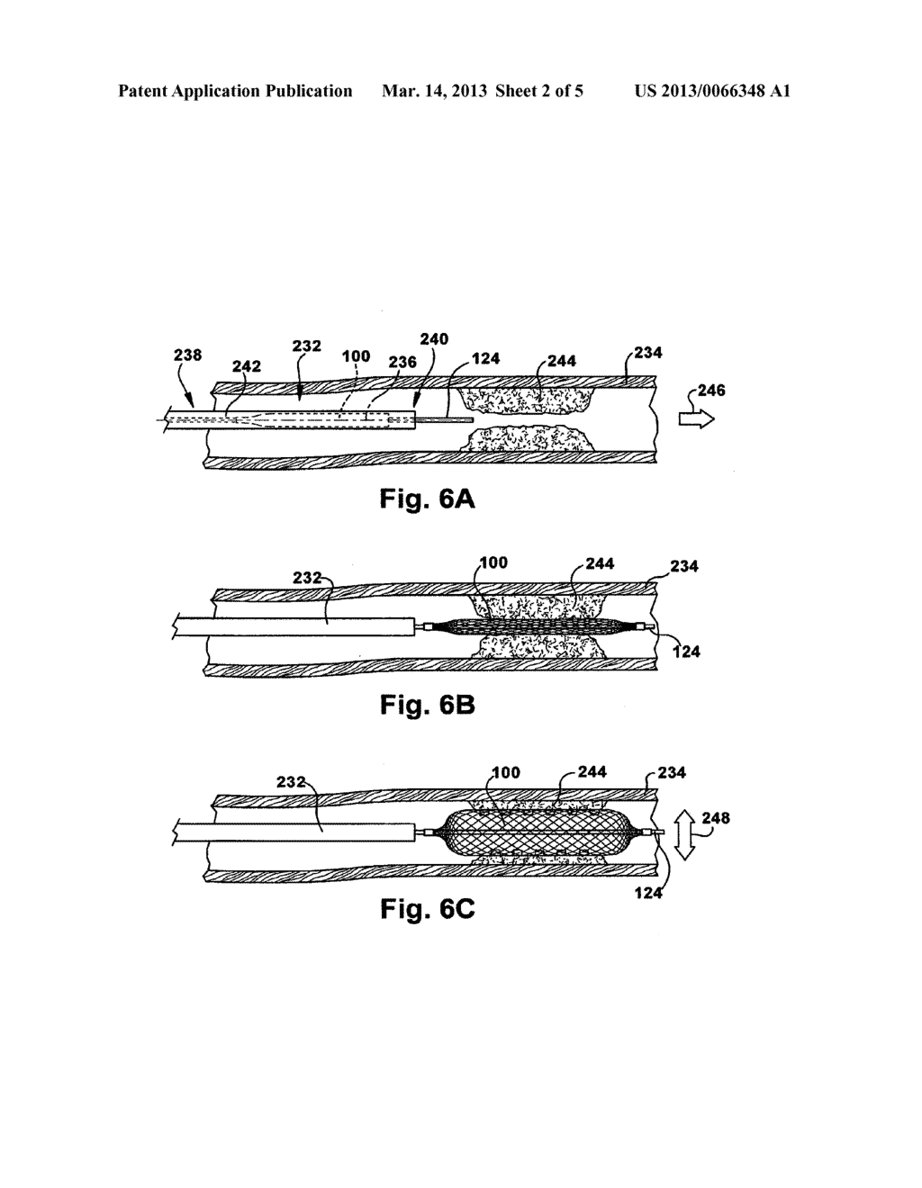 METHOD AND APPARATUS FOR INCREASING BLOOD FLOW THROUGH AN OBSTRUCTED BLOOD     VESSEL - diagram, schematic, and image 03
