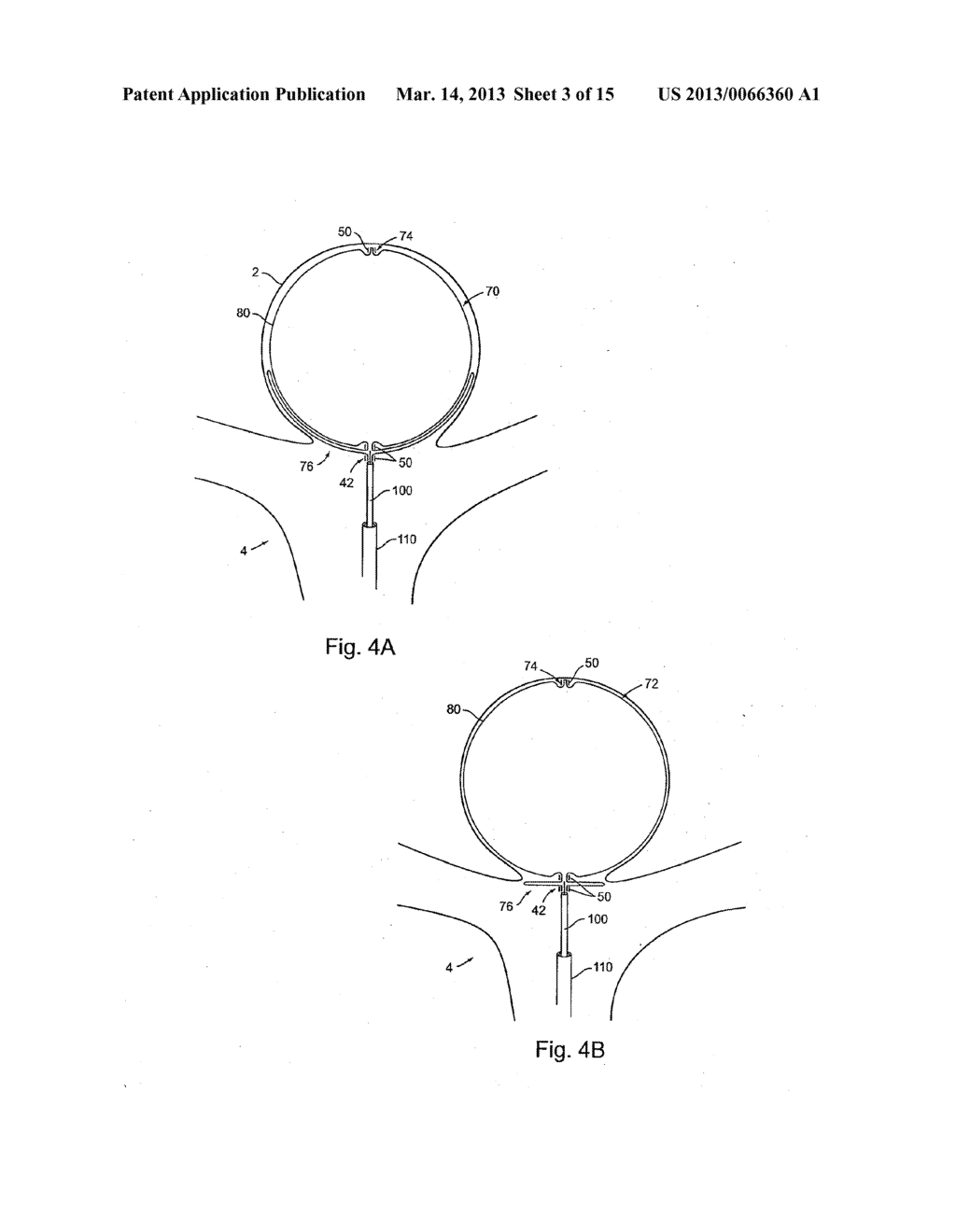 Braid-Ball Embolic Devices - diagram, schematic, and image 04