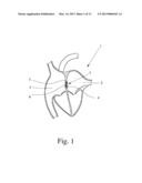 Occluder diagram and image