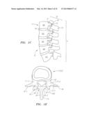 Systems, Devices and Methods for the Correction of Spinal Deformities diagram and image