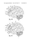 TECHNIQUES FOR SELECTING SIGNAL DELIVERY SITES AND OTHER PARAMETERS FOR     TREATING DEPRESSION AND OTHER NEUROLOGICAL DISORDERS, AND ASSOCIATED     SYSTEMS AND METHODS diagram and image