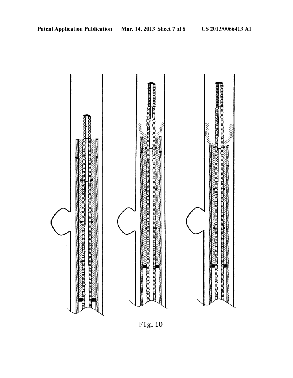 SURGICAL APPARATUS FOR ANEURYSMS - diagram, schematic, and image 08