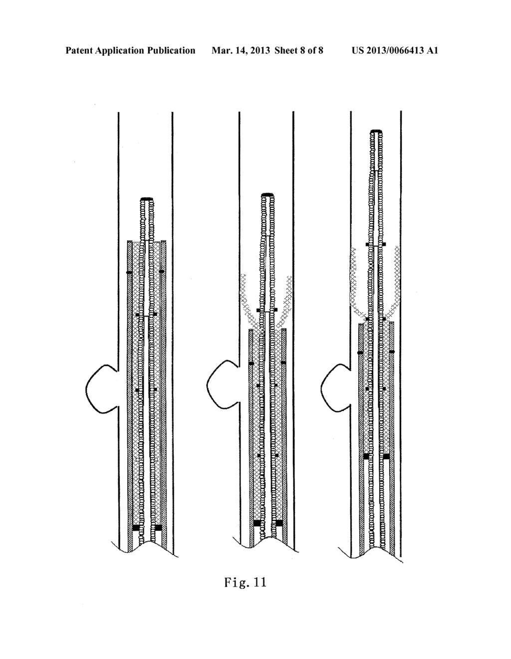 SURGICAL APPARATUS FOR ANEURYSMS - diagram, schematic, and image 09