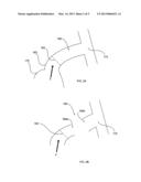 INTRAVASCULAR BLOOD PUMP AND METHOD OF IMPLANTATION diagram and image