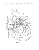 INTRAVASCULAR BLOOD PUMP AND METHOD OF IMPLANTATION diagram and image