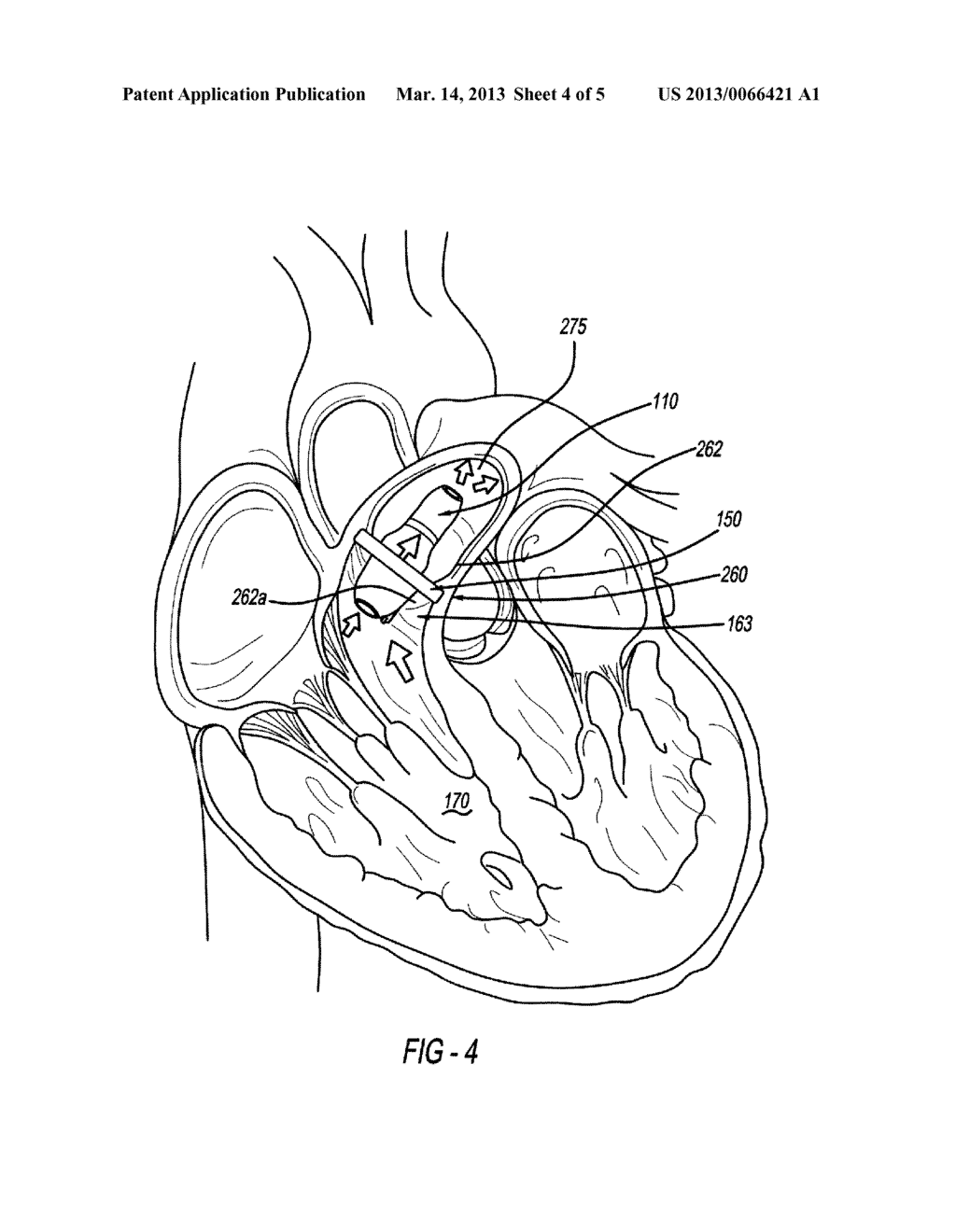 INTRAVASCULAR BLOOD PUMP AND METHOD OF IMPLANTATION - diagram, schematic, and image 05