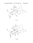 INTRAVASCULAR BLOOD PUMP AND METHOD OF IMPLANTATION diagram and image