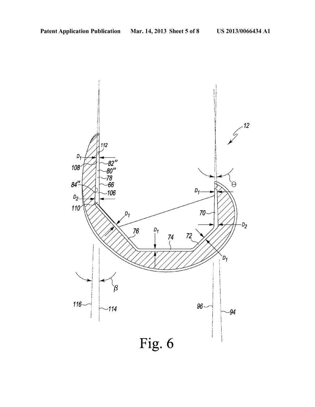 FEMORAL COMPONENT OF A KNEE PROSTHESIS HAVING AN ANGLED CEMENT POCKET - diagram, schematic, and image 06