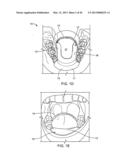 TONGUE RETAINING ORAL APPLIANCE diagram and image