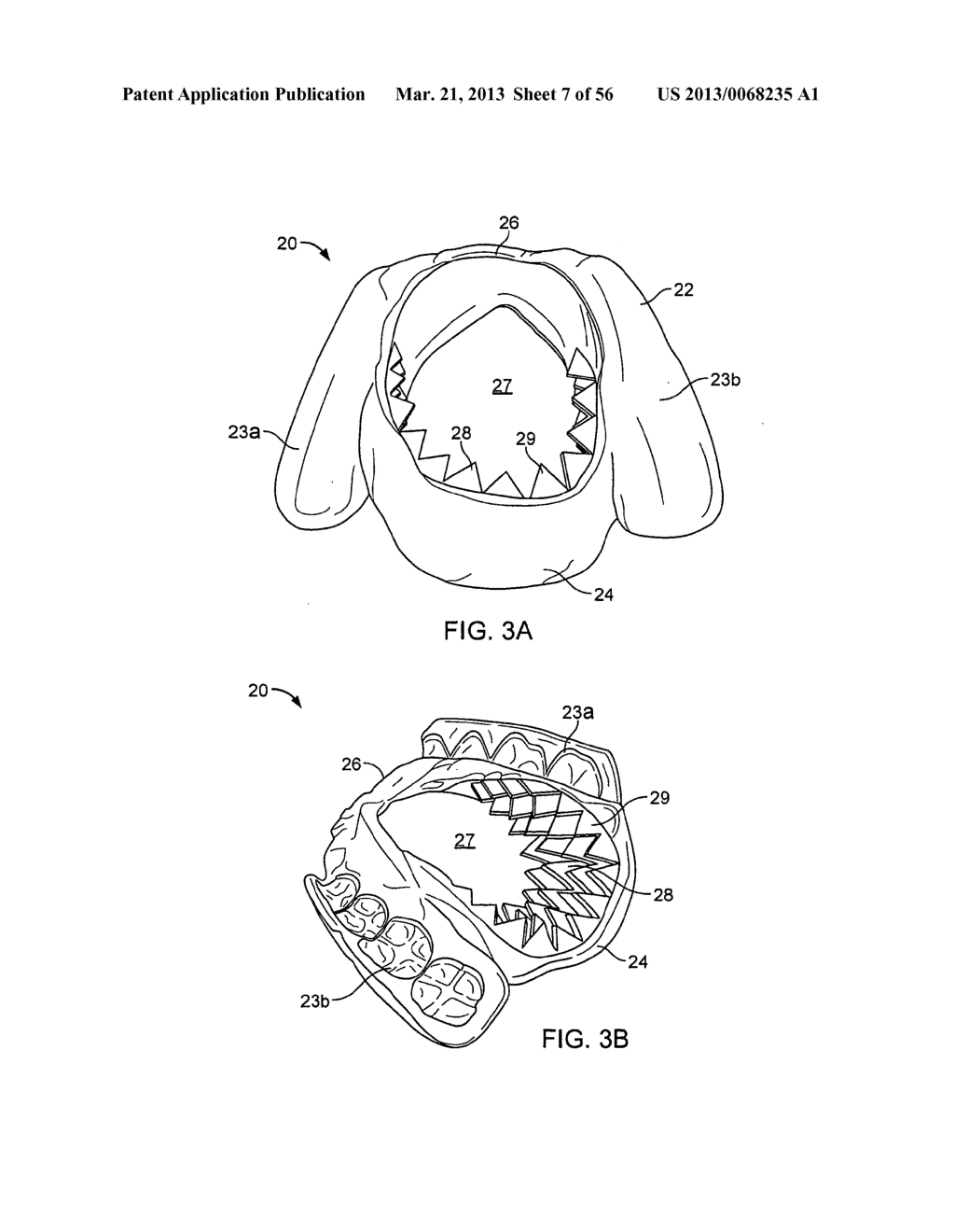 TONGUE RETAINING ORAL APPLIANCE - diagram, schematic, and image 08