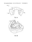 TONGUE RETAINING ORAL APPLIANCE diagram and image