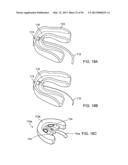 TONGUE RETAINING ORAL APPLIANCE diagram and image