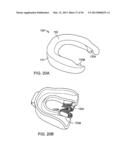 TONGUE RETAINING ORAL APPLIANCE diagram and image