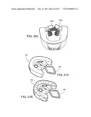 TONGUE RETAINING ORAL APPLIANCE diagram and image