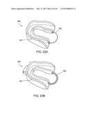 TONGUE RETAINING ORAL APPLIANCE diagram and image