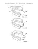 TONGUE RETAINING ORAL APPLIANCE diagram and image