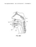 TONGUE RETAINING ORAL APPLIANCE diagram and image