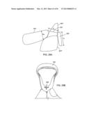 TONGUE RETAINING ORAL APPLIANCE diagram and image