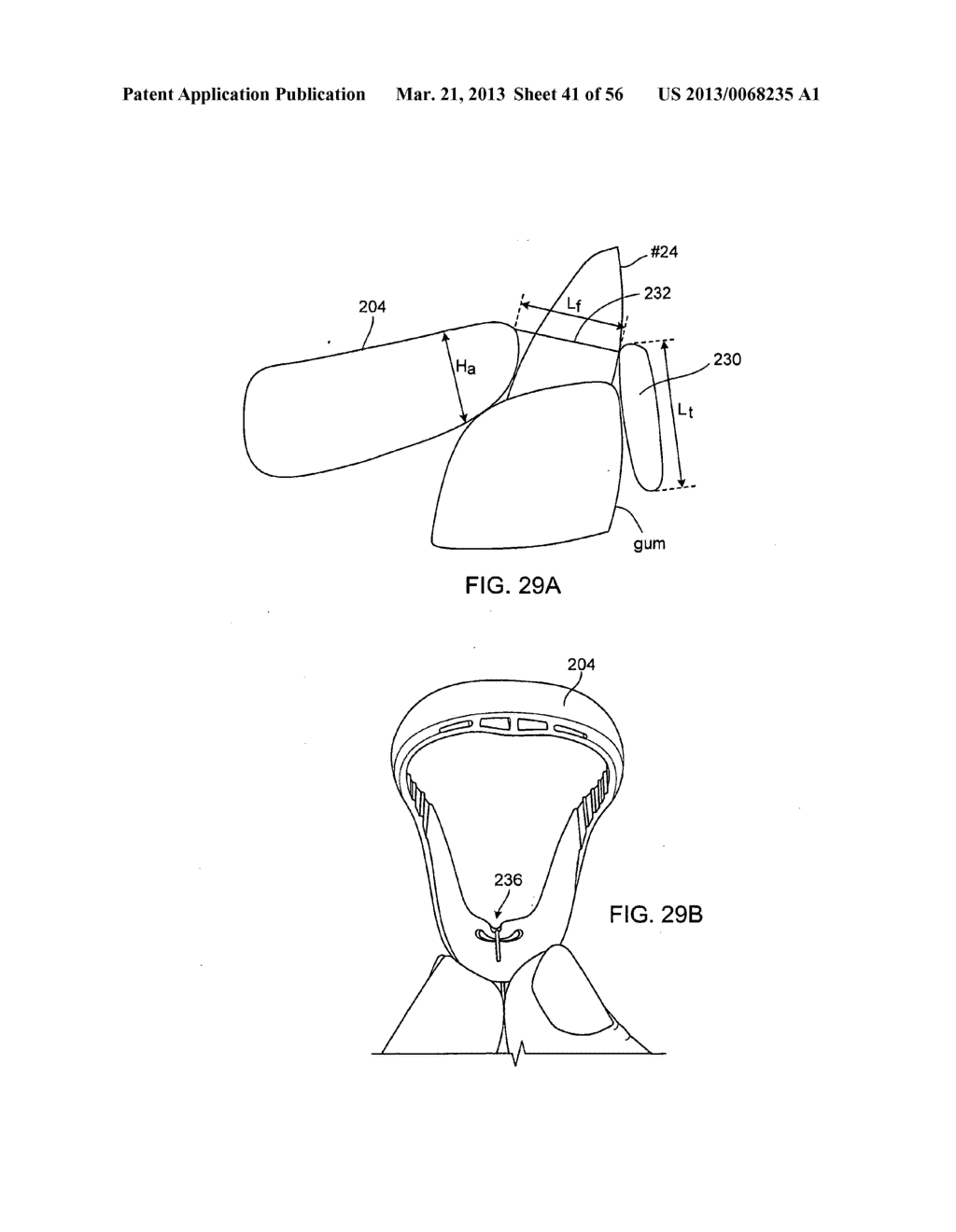 TONGUE RETAINING ORAL APPLIANCE - diagram, schematic, and image 42