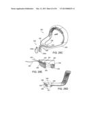 TONGUE RETAINING ORAL APPLIANCE diagram and image