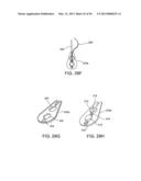 TONGUE RETAINING ORAL APPLIANCE diagram and image