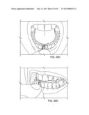 TONGUE RETAINING ORAL APPLIANCE diagram and image