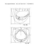 TONGUE RETAINING ORAL APPLIANCE diagram and image