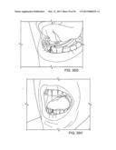 TONGUE RETAINING ORAL APPLIANCE diagram and image