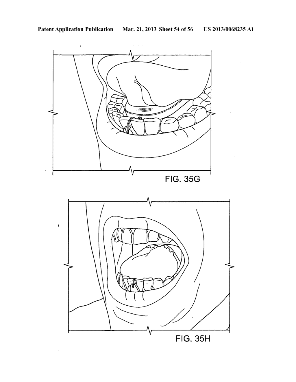 TONGUE RETAINING ORAL APPLIANCE - diagram, schematic, and image 55