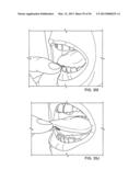 TONGUE RETAINING ORAL APPLIANCE diagram and image