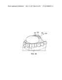 TONGUE RETAINING ORAL APPLIANCE diagram and image
