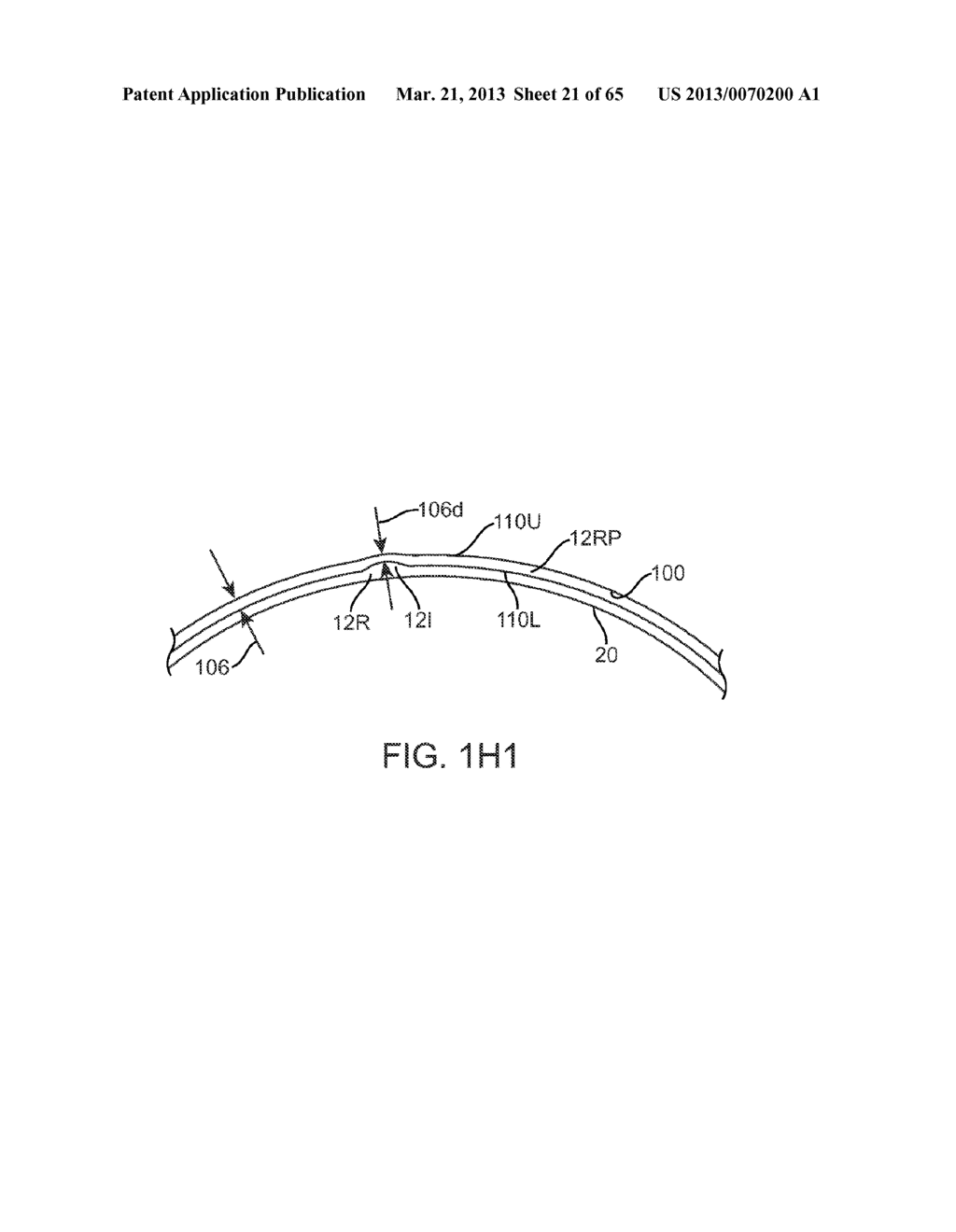 Conformable Therapeutic Shield for Vision and Pain - diagram, schematic, and image 22