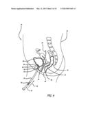 TRANSLUMINAL DRUG DELIVERY METHODS AND DEVICES diagram and image