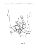 TRANSLUMINAL DRUG DELIVERY METHODS AND DEVICES diagram and image