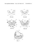 EDENTULOUS SURGICAL GUIDE diagram and image