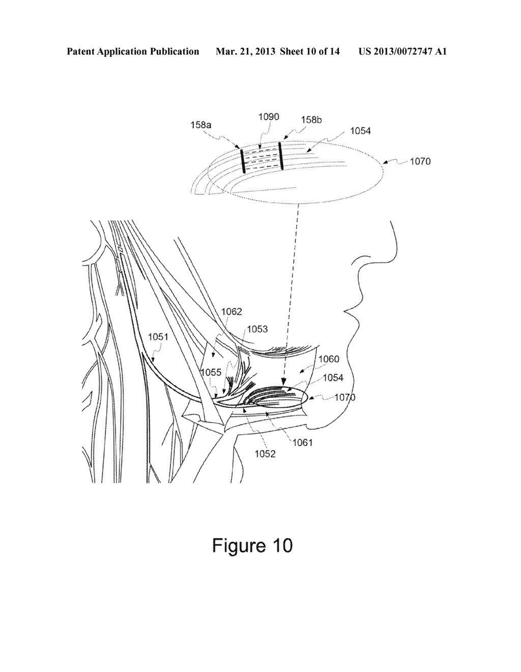 Apparatus and Method for Detecting a Sleep Disordered Breathing Precursor - diagram, schematic, and image 11