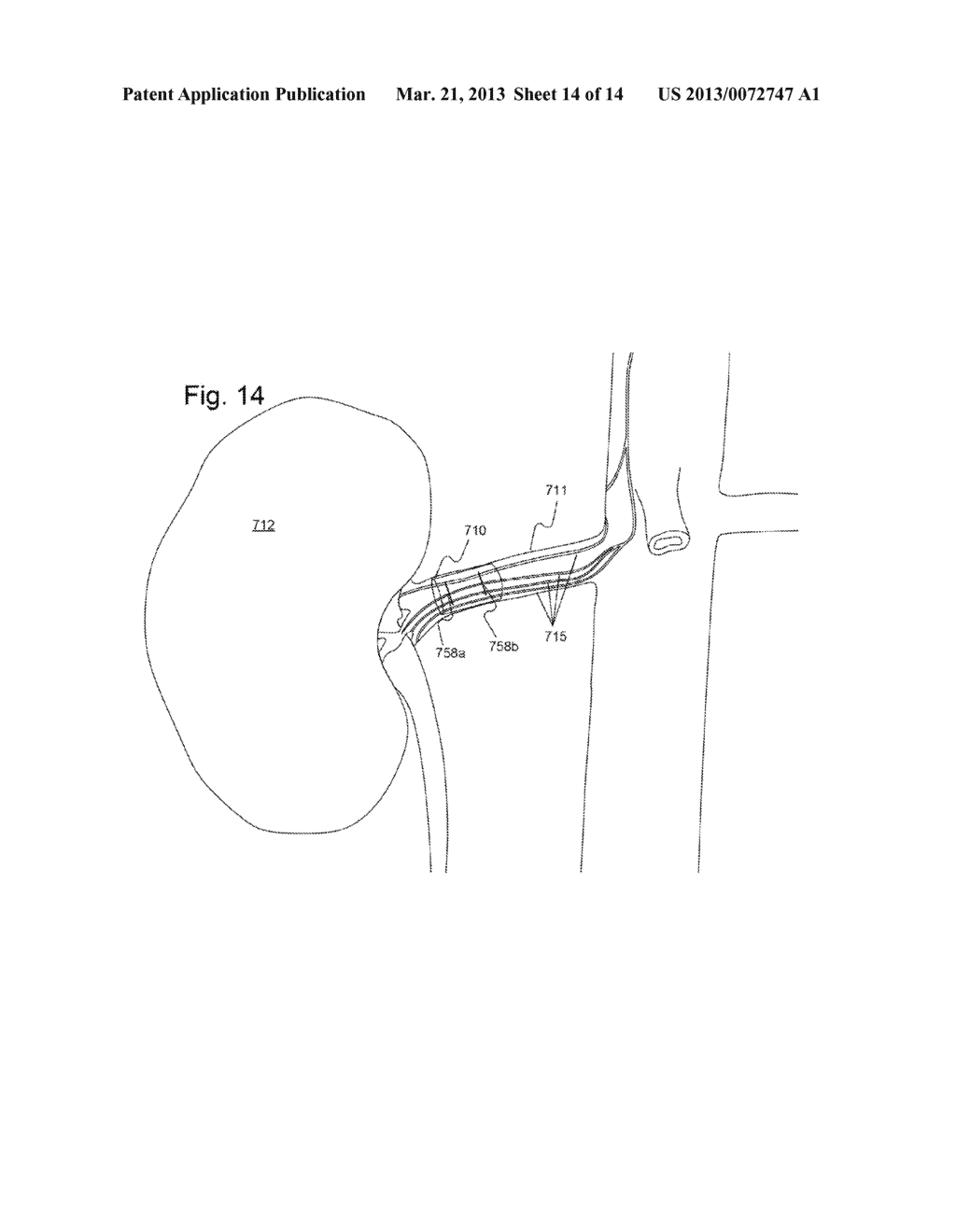 Apparatus and Method for Detecting a Sleep Disordered Breathing Precursor - diagram, schematic, and image 15