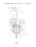 SYSTEMS AND METHODS FOR TREATING OBESITY AND OTHER GASTROINTESTINAL     CONDITIONS diagram and image