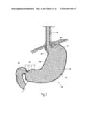 SYSTEMS AND METHODS FOR TREATING OBESITY AND OTHER GASTROINTESTINAL     CONDITIONS diagram and image