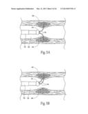 SYSTEMS AND METHODS FOR TREATING OBESITY AND OTHER GASTROINTESTINAL     CONDITIONS diagram and image