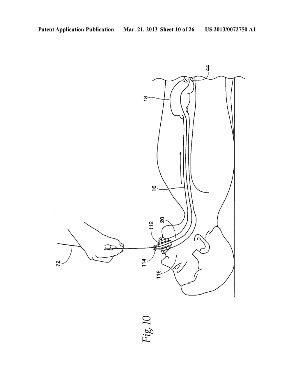 SYSTEMS AND METHODS FOR TREATING OBESITY AND OTHER GASTROINTESTINAL     CONDITIONS - diagram, schematic, and image 11