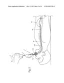 SYSTEMS AND METHODS FOR TREATING OBESITY AND OTHER GASTROINTESTINAL     CONDITIONS diagram and image