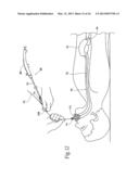 SYSTEMS AND METHODS FOR TREATING OBESITY AND OTHER GASTROINTESTINAL     CONDITIONS diagram and image