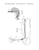 SYSTEMS AND METHODS FOR TREATING OBESITY AND OTHER GASTROINTESTINAL     CONDITIONS diagram and image