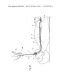 SYSTEMS AND METHODS FOR TREATING OBESITY AND OTHER GASTROINTESTINAL     CONDITIONS diagram and image